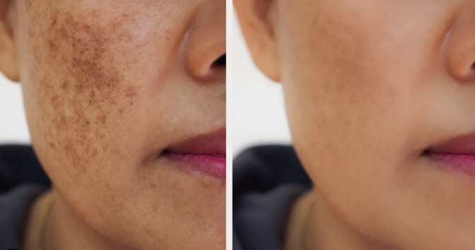 Laser Therapy Before After